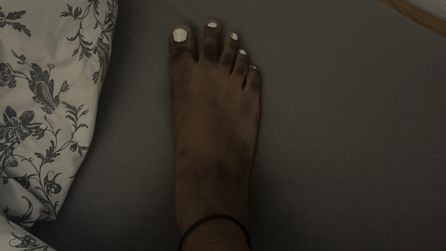 Black feet with crusty nail polish